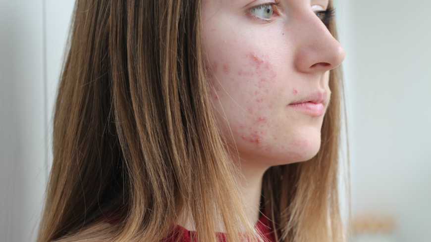 Flickor får akne tidigare än pojkar vilket hänger ihop med att puberteten inträder tidigare hos dem. Foto: Shutterstock